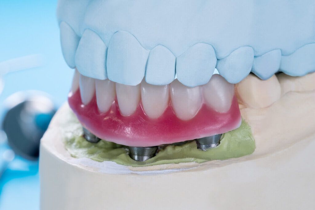 Closeup/ Dental implants supported overdenture on blue background.