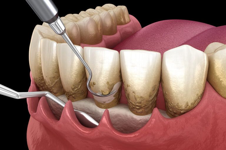 Scaling and root planing (conventional periodontal therapy).