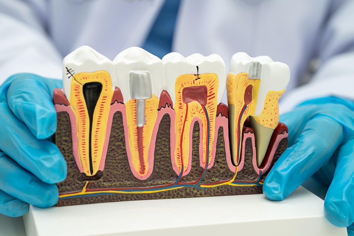 The model shows the removal of infected pulp from the tooth roots, which are then cleaned, filled, and sealed.