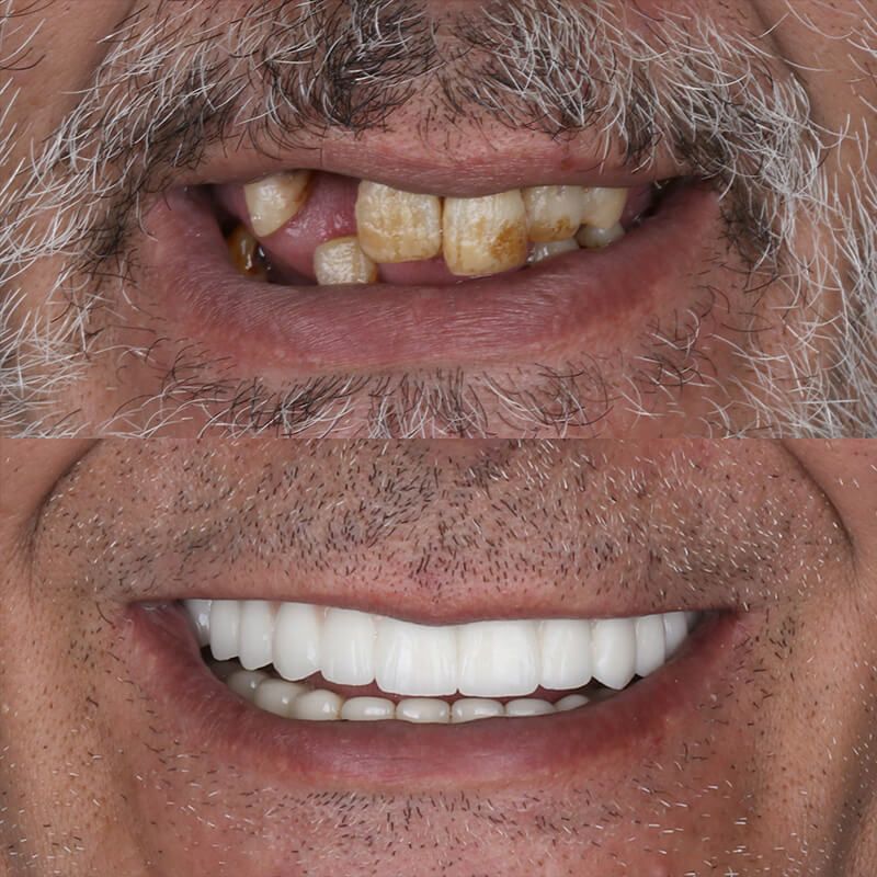 gallery smile1 before and after