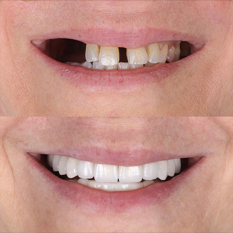 gallery smile2 before and after