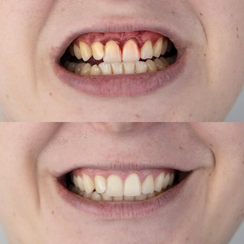 gallery smile3 before and after