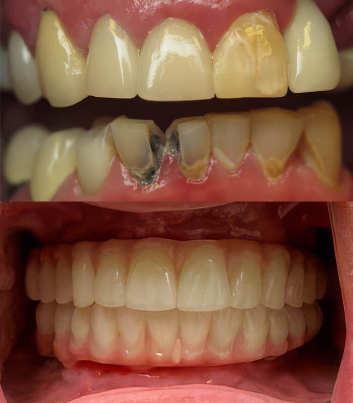 All-on-X before & after