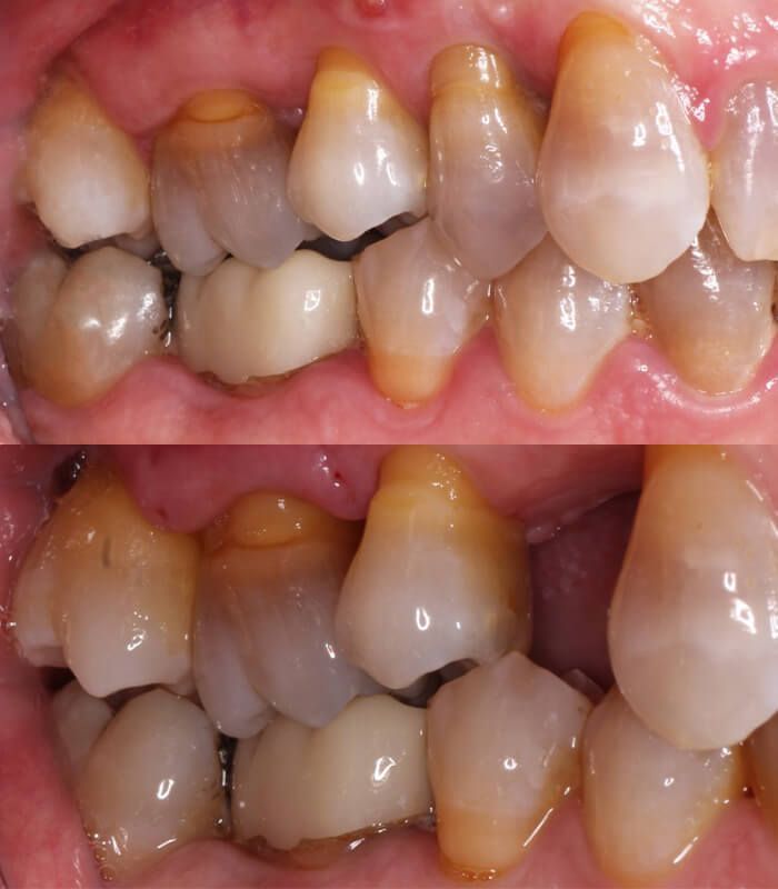 before & after bone grafting1