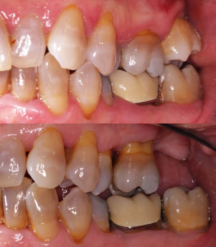 before & after bone grafting2