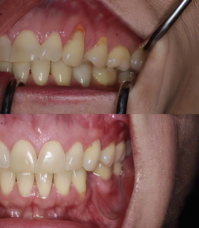 Gum grafting before & after