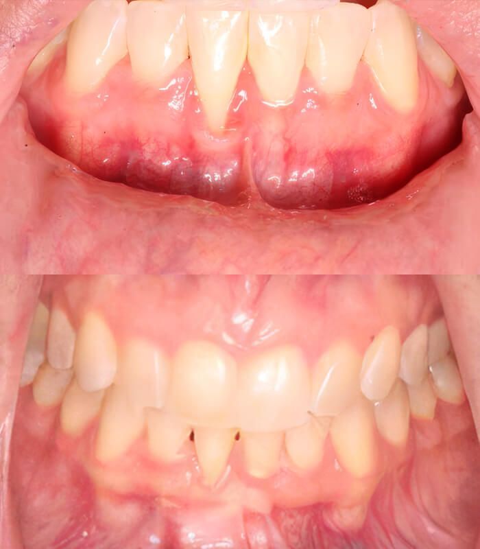 Before & After Gum Grafting