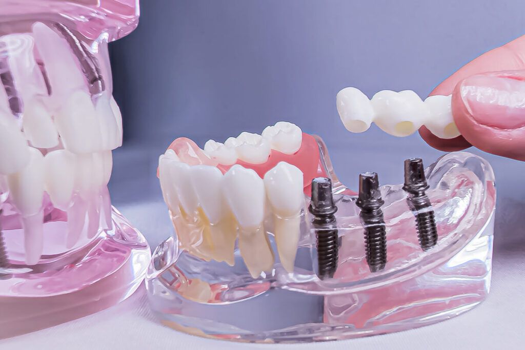 Dental Implants on mouth model