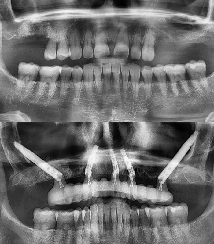 Before & After zygomatic Implants