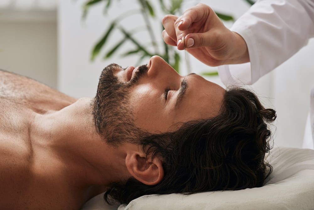 Acupuncturist inserts acupuncture needles into acupuncture point on male head for headaches. Traditional chinese medicine, reflexology